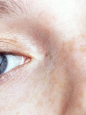 How To Choose The Right Concealer To Banish Dark Circles Hero