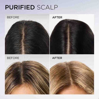 Hyaluron Pure Bundle Before After