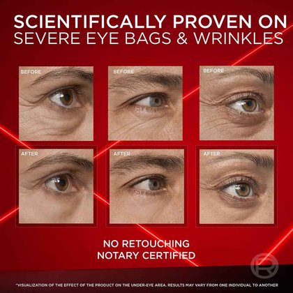 Before and after of the Revitalift eye cream for wrinkles - visibly reduces severe eye bags and wrinkles